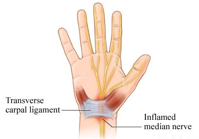 Carpal Tunnel Syndrome in Mesa, Chandler, Gilbert, Tempe, and Phoenix