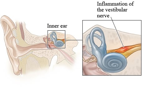 Blogg Vestibulær nerve 