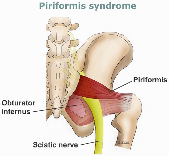 Physiotherapist Burlington – Sciatica and Disc Herniation