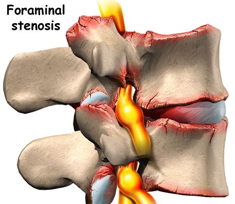 Spinal Stenosis is a common cause of low back pain and sciatica - Capitol  Pain Institute