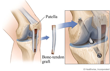 I've Torn My ACL. Do I Need Surgery?