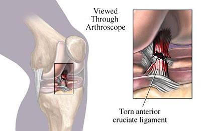 Knee Ligament Injuries Virginia Beach, ACL Tears