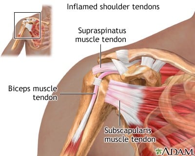 What Is Rotator Cuff Tendonitis?