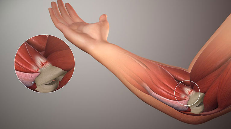 golfer's elbow, anatomy, what is, physiotherapy, toronto, anatomy,