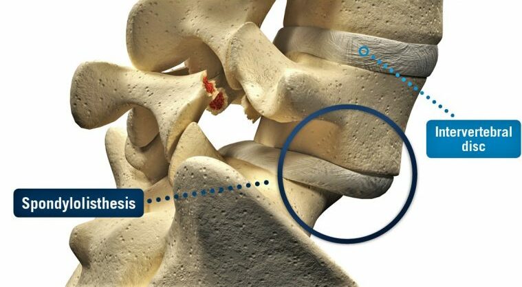 SPONDYLOLISTHESIS, physiotherapy, physiotherapist