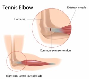 physiotherapy for tennis elbow, physiotherapy for lateral epicondylitis, tennis elbow physiotherapist, in Toronto