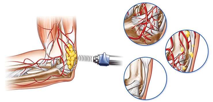 Shockwave Therapy Burlington - Burlington Sports Therapy