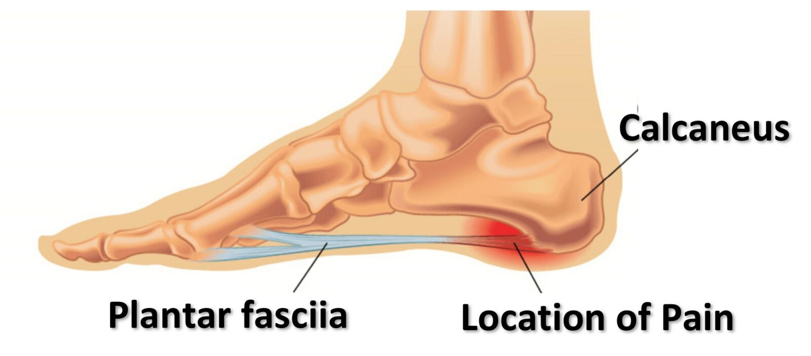 A step in right direction – Plantar Fasciitis Treatment - Johari