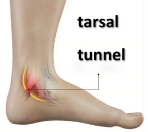 anatomical tarsal tunnel