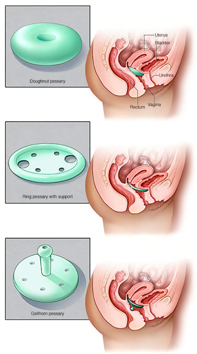Vaginal Prolapse (Non-Surgical) Treatment Toronto