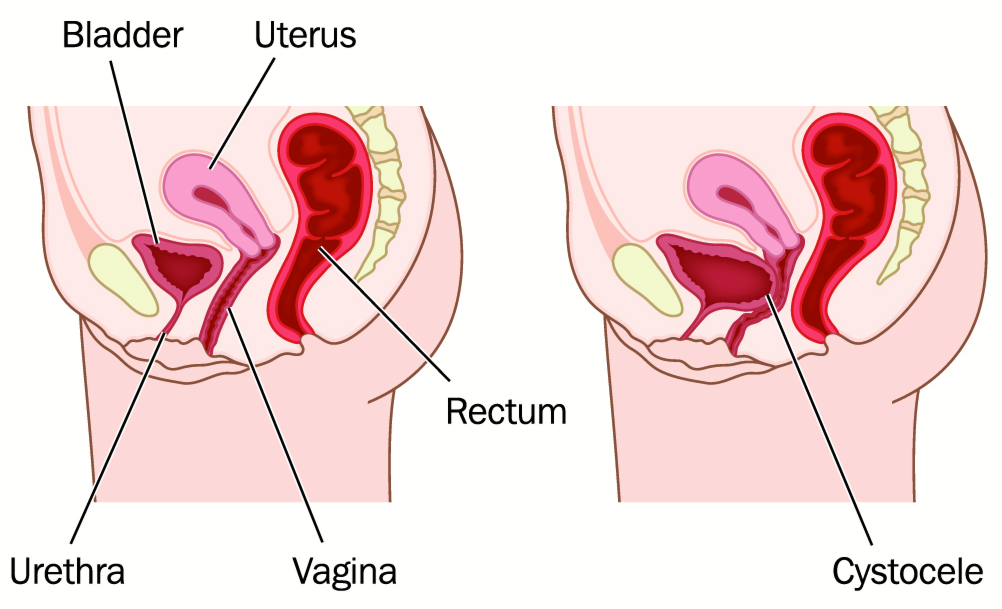 A Cystocele is Also Known As a Bladder Prolapse, a Fallen Bladder, a Prolapsed  Bladder, or an Anterior Vaginal Prolapse Stock Illustration - Illustration  of infection, cancer: 272796958