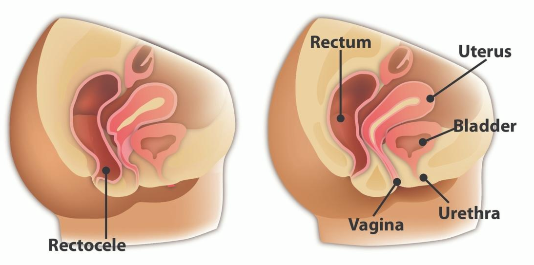 Pelvic rectocele bladder prolapse normal abnormal anatomy