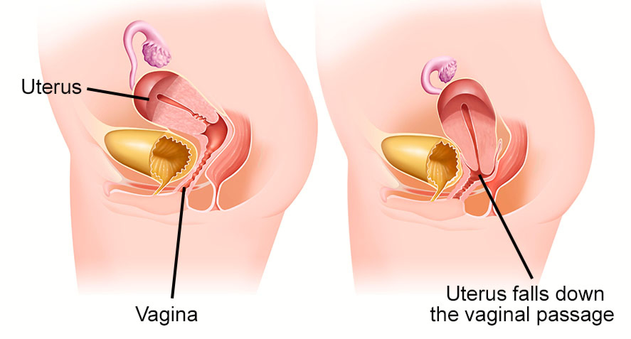 What is Pelvic Organ Prolapse?  Types of Prolapse, Diagnosis, Treatment