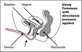 manage prolapse The femmeze tool for incomplete emptying of your bowels with a rectal prolapse to avoid pocketing