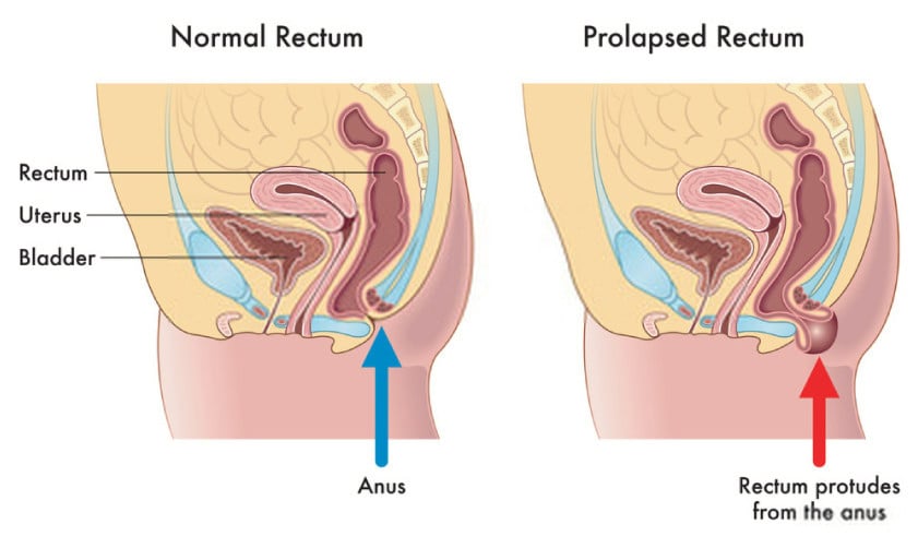 Pelvic Organ Prolapse  Concise Medical Knowledge