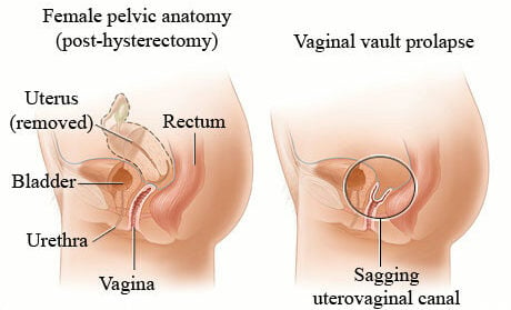 The prolapsed bladder was pushed back to the abdominal cavity through