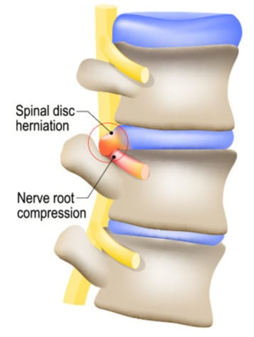 What's Worse—Bulging or Herniated Discs?