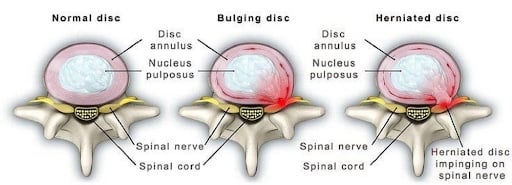 Disc Herniations and Disc Bulges  Your Guide to Causes and Treatment