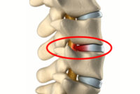 model of low back lumbar spine showing a bulging disc hernation