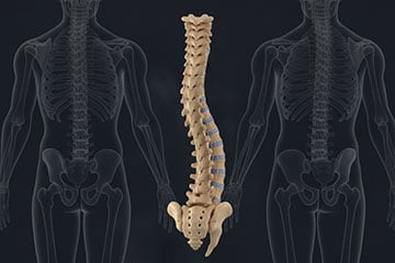 spine-showing-scoliosis-preview