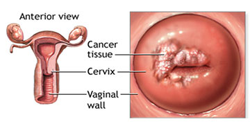 cervical-cancer-image