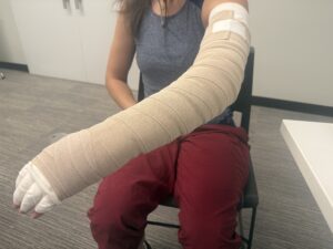 Lymphedema patient who's left arm has been fully bandaged using Complete Decongestive Therapy