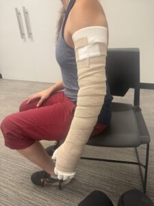 left arm of lymphedema patient who has been fully bandaged using Complete Decongestive Therapy